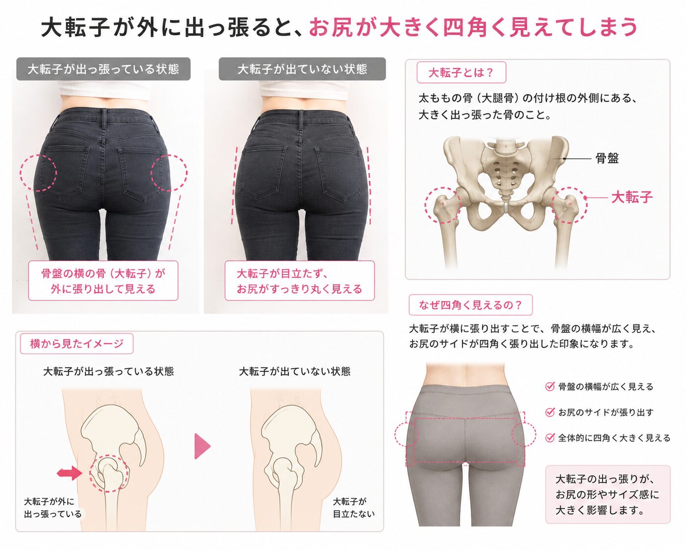 大転子の位置で骨盤が横に広がる玉ねぎ尻の原因