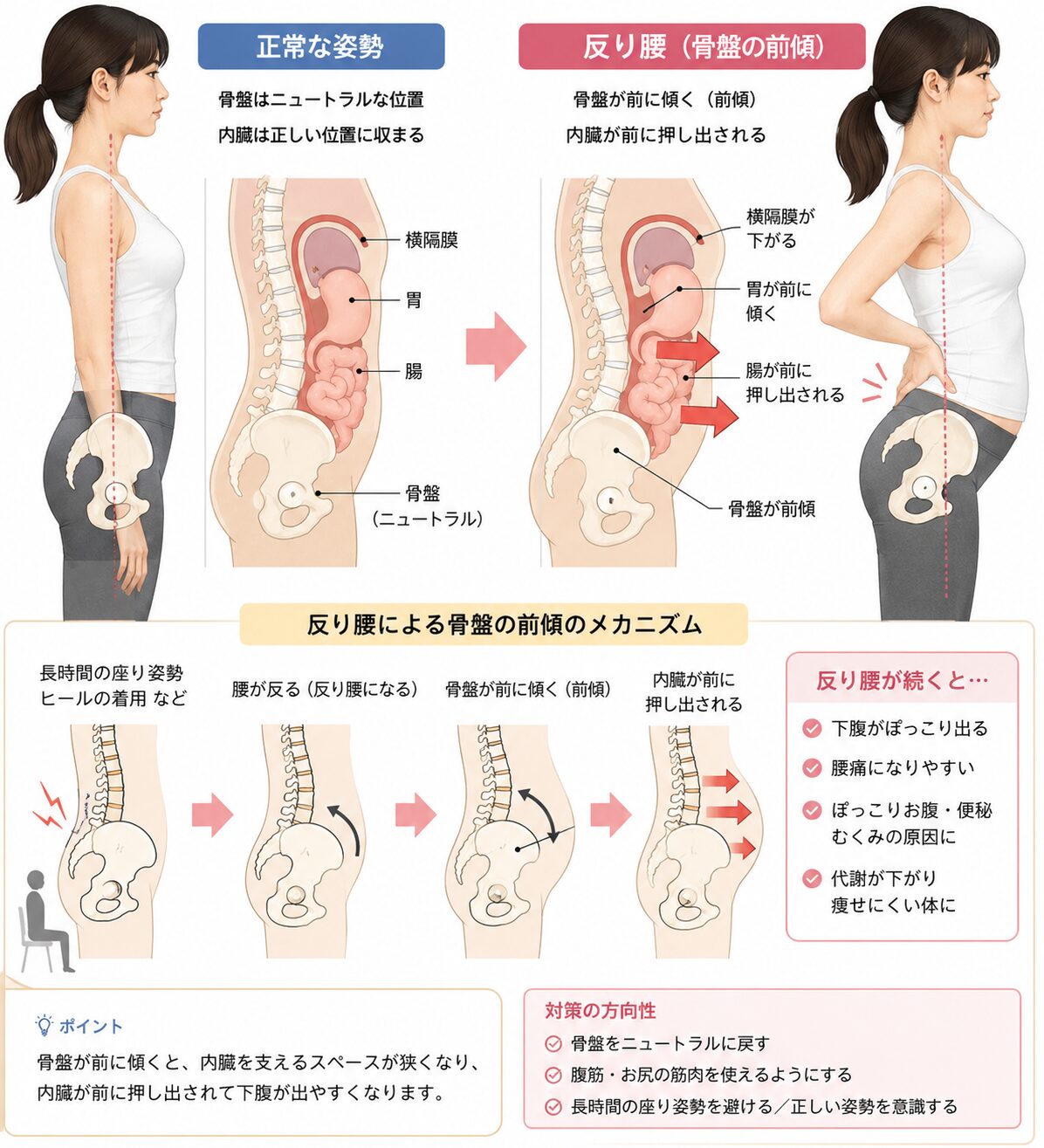 反り腰と骨盤前傾による下腹ぽっこりの原因