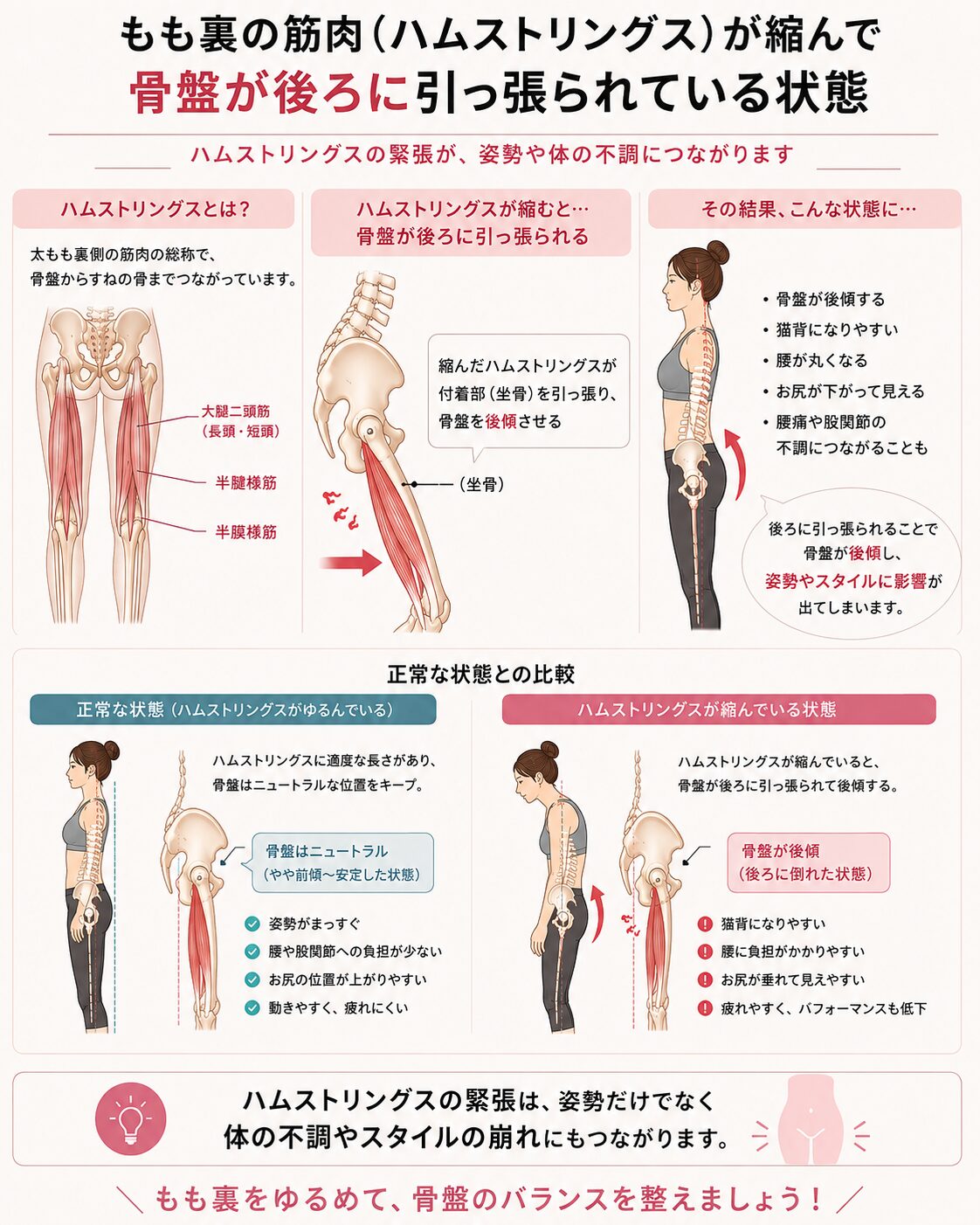 もも裏の縮みによる骨盤後傾と四角いお尻の関係