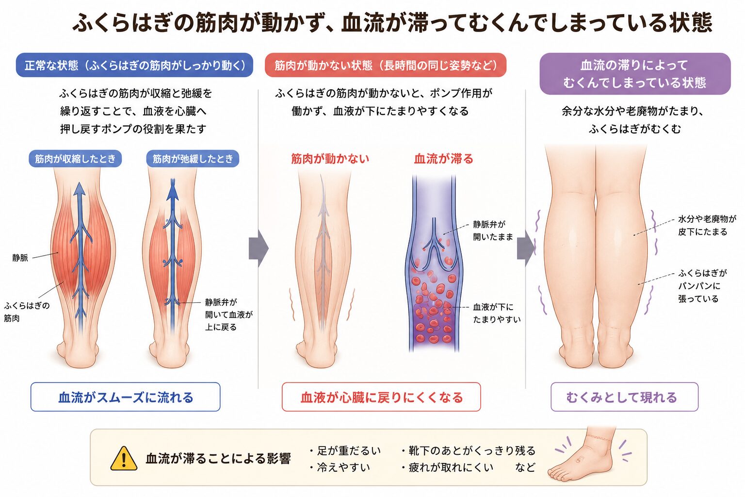 ふくらはぎのポンプ活動停止による足のむくみ